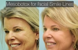 Botox Results Dallas