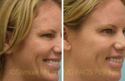 asian nose job asian nose job