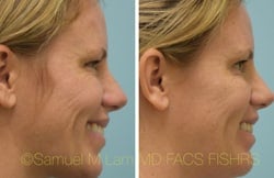 jaw reduction jaw reduction