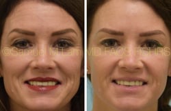 lip reduction lip reduction