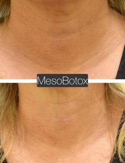 lip reduction lip reduction