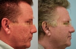 Acne Scarring Before and After