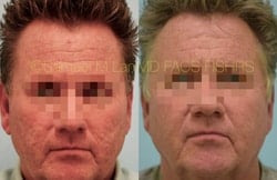 Acne Scarring Before and After
