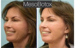 lip reduction lip reduction