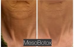 asian nose job asian nose job