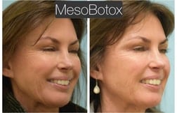 jaw reduction jaw reduction