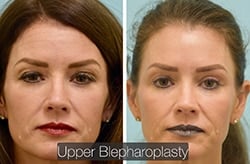 Eyelid Surgery Before & After