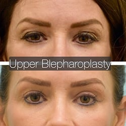 Eyelid Surgery Before & After