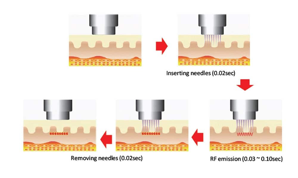 RF Microneedle