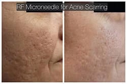 lip reduction lip reduction
