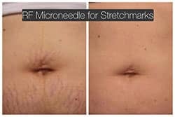 jaw reduction jaw reduction