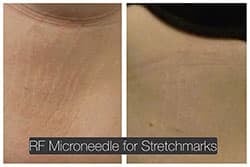 lip reduction lip reduction