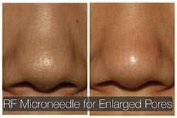 jaw reduction jaw reduction