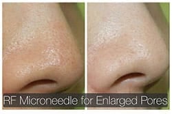 lip reduction lip reduction
