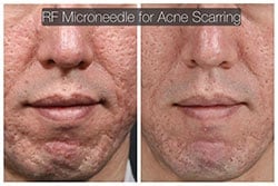 jaw reduction jaw reduction