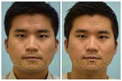 lip reduction lip reduction