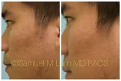 asian nose job asian nose job
