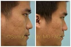 jaw reduction jaw reduction