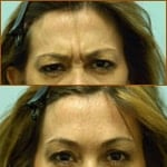 Fillers and Injectables Video Testimonials