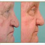 aging nose