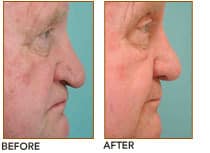 Aging Nosejob