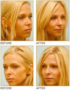 Cheek Augmentation