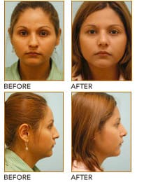 crooked nose rhinoplasty