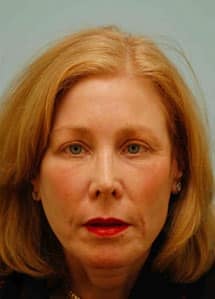 facial_rejuvenation_tutorial_17b