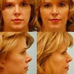 functional rhinoplasty