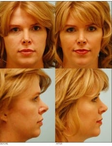 functional_nose_job