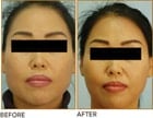 jaw reduction