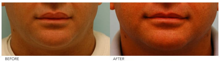 Lip Reduction Before and After Photos