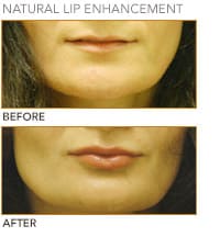 lip_augumentation