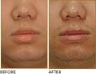 lip reduction