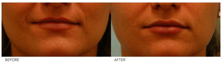 Lip Enhancement Before and After Photos