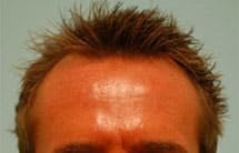 skin_rejuvenation_tutorial_10b
