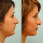 tension nose