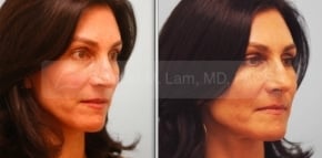 Full Facial Fat Transfer