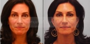 Full Facial Fat Transfer