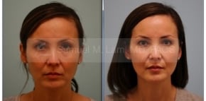Fat Grafting and Silicone Lip Enhancement