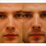 trauma rhinoplasty