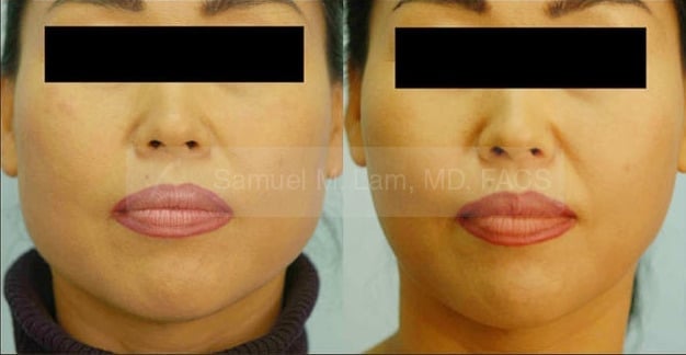 asian nose job asian nose job