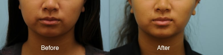 jaw reduction jaw reduction
