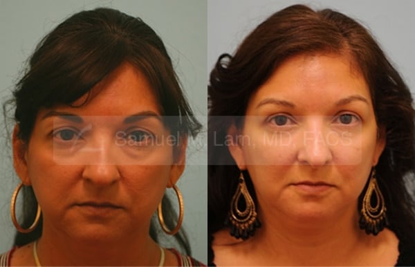 asian nose job