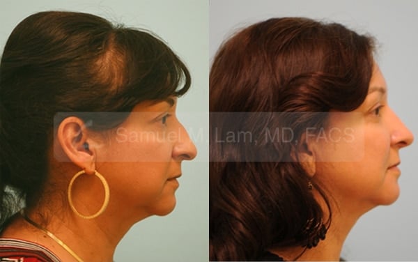 lip reduction
