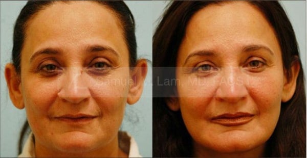 Skin Lesions / Mole Removal Photos