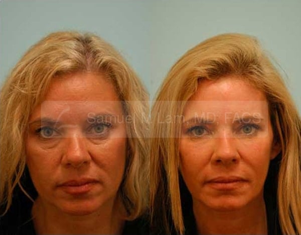 Skin Resurfacing Photos