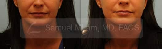 lip reduction