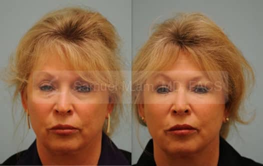 jaw reduction