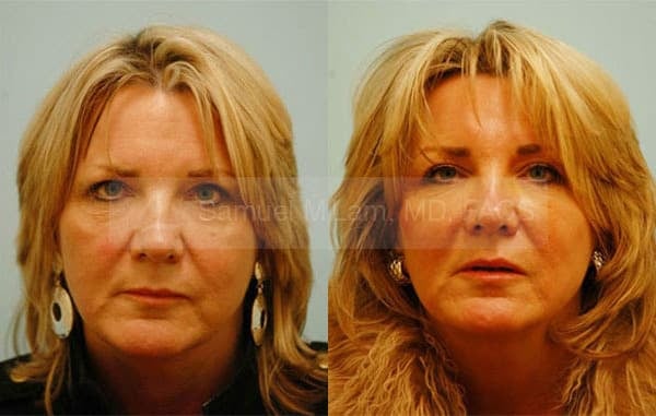 jaw reduction